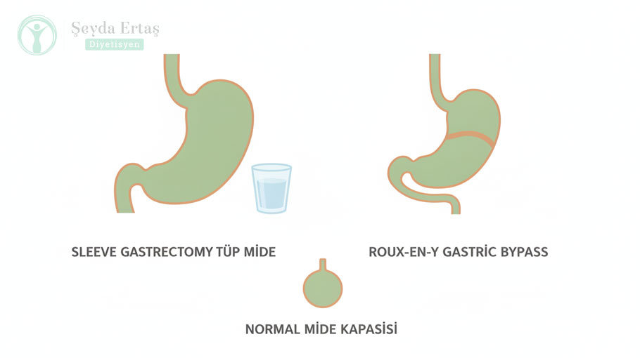 Sleeve gastrektomi ve gastrik bypass sonrası mide hacminin karşılaştırmalı şeması